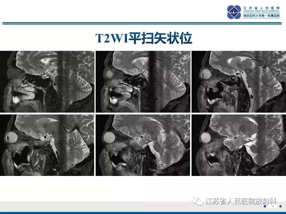 影像PPT - 【PPT】腺样囊腺癌-6
