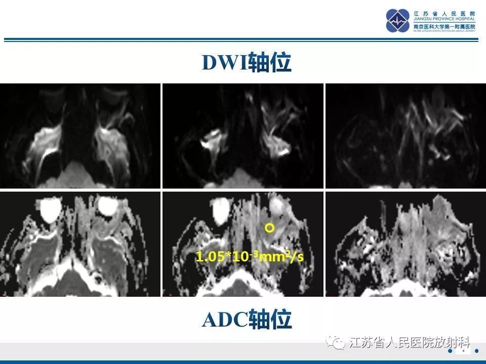 影像PPT - 【PPT】腺样囊腺癌-7