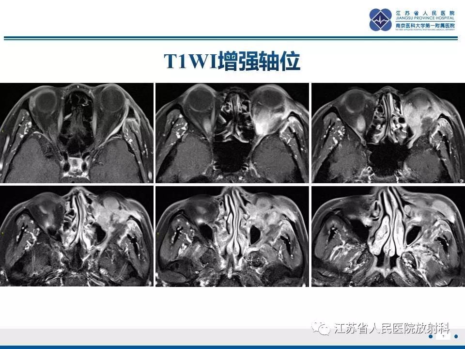 影像PPT - 【PPT】腺样囊腺癌-8