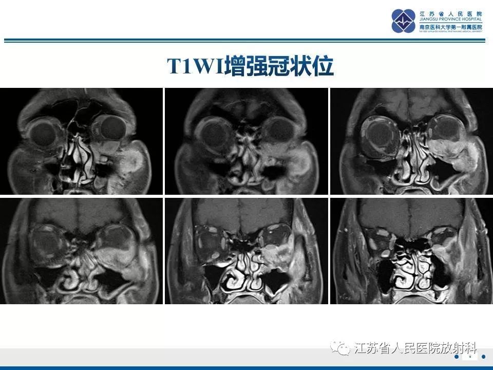 影像PPT - 【PPT】腺样囊腺癌-9