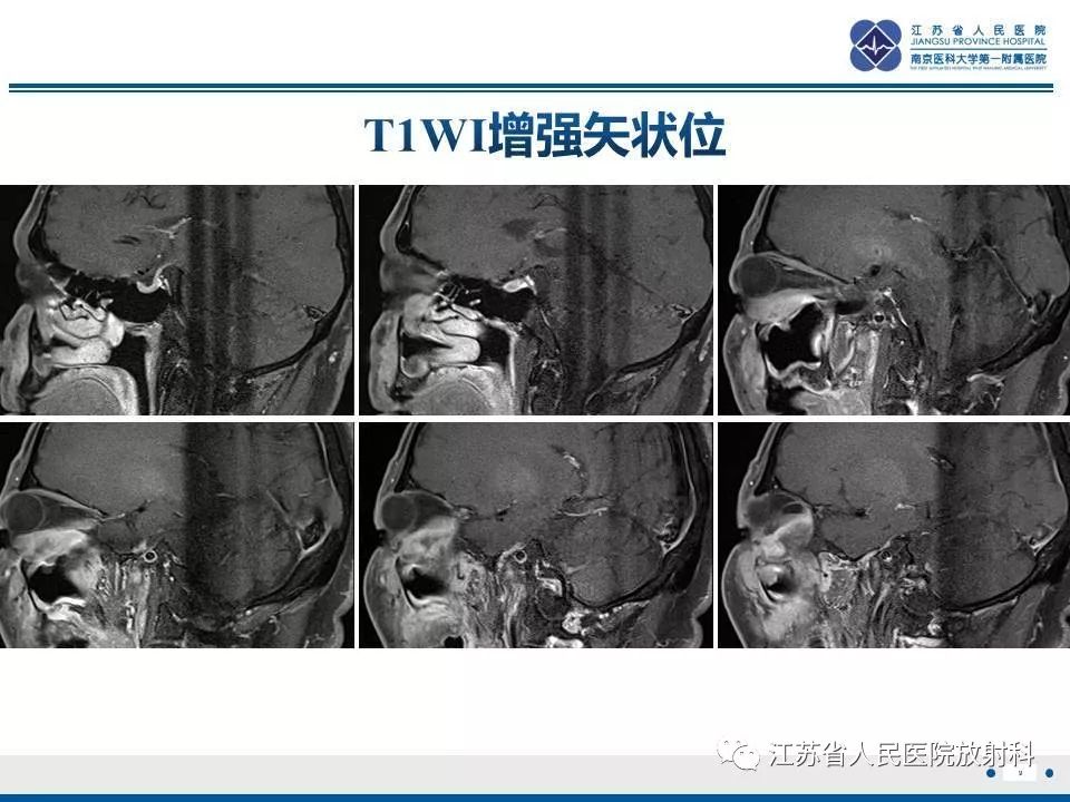 影像PPT - 【PPT】腺样囊腺癌-10