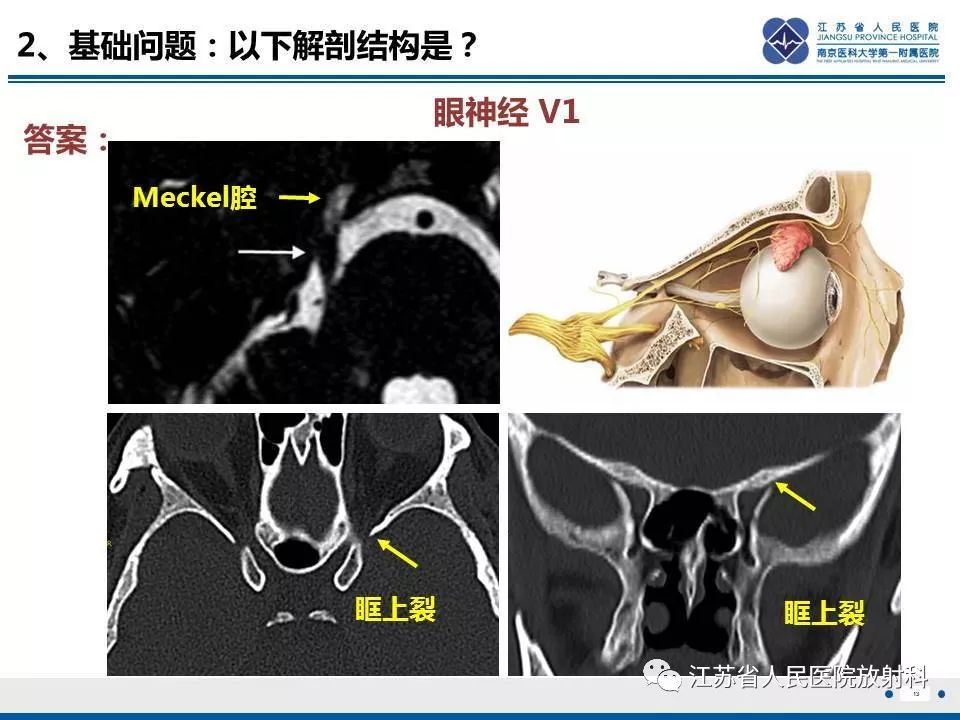 影像PPT - 【PPT】腺样囊腺癌-14