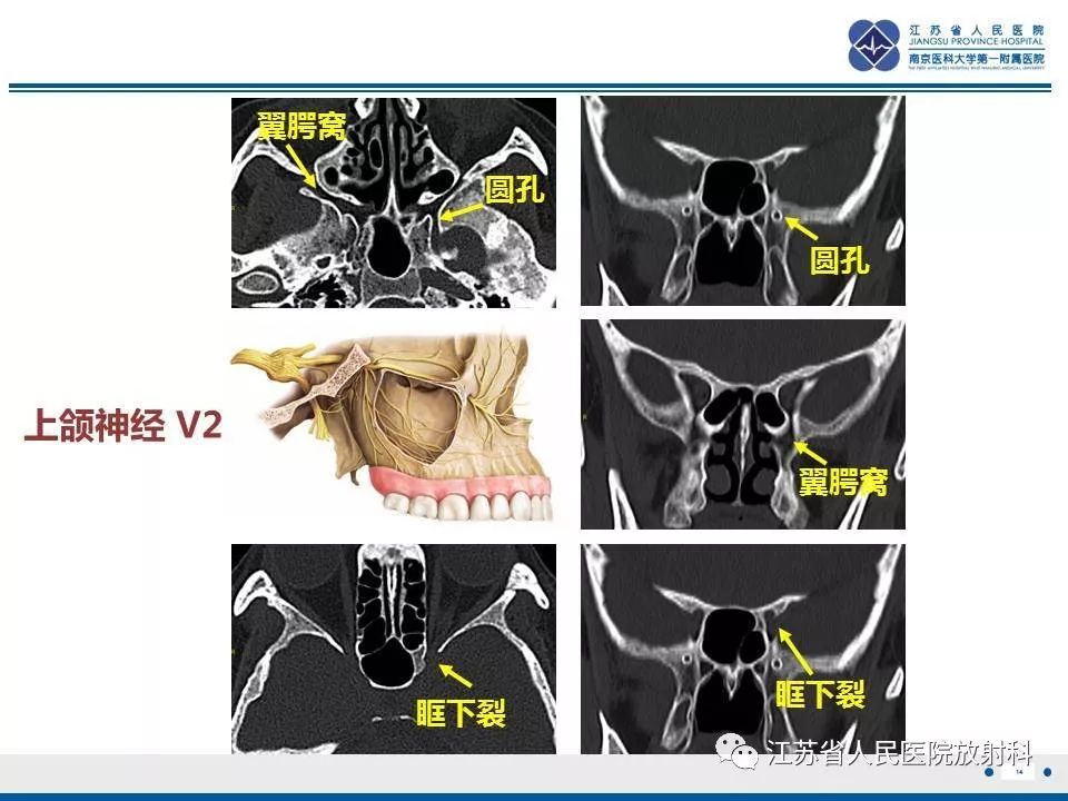 影像PPT - 【PPT】腺样囊腺癌-15