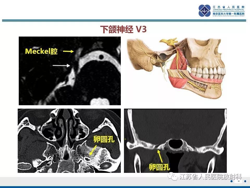 影像PPT - 【PPT】腺样囊腺癌-16