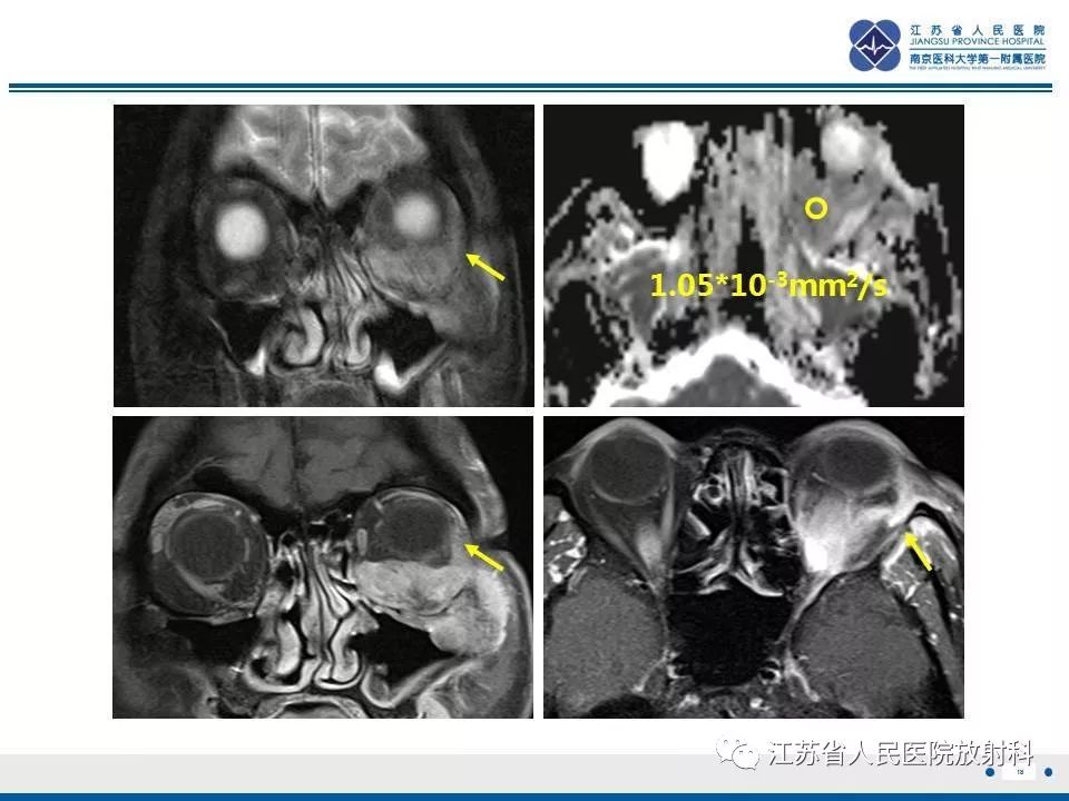 影像PPT - 【PPT】腺样囊腺癌-19