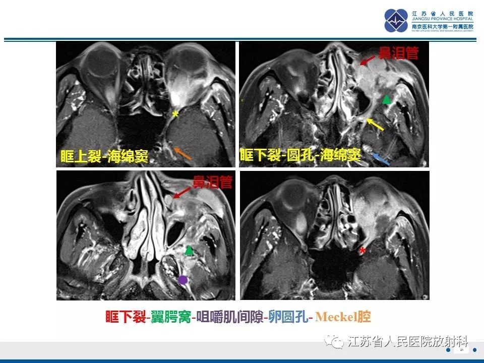 影像PPT - 【PPT】腺样囊腺癌-22