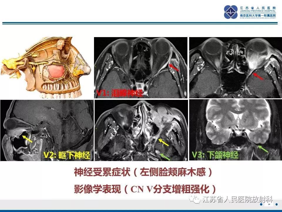 影像PPT - 【PPT】腺样囊腺癌-25