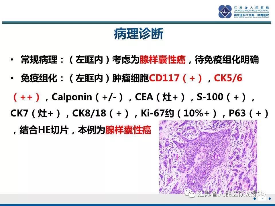 影像PPT - 【PPT】腺样囊腺癌-29