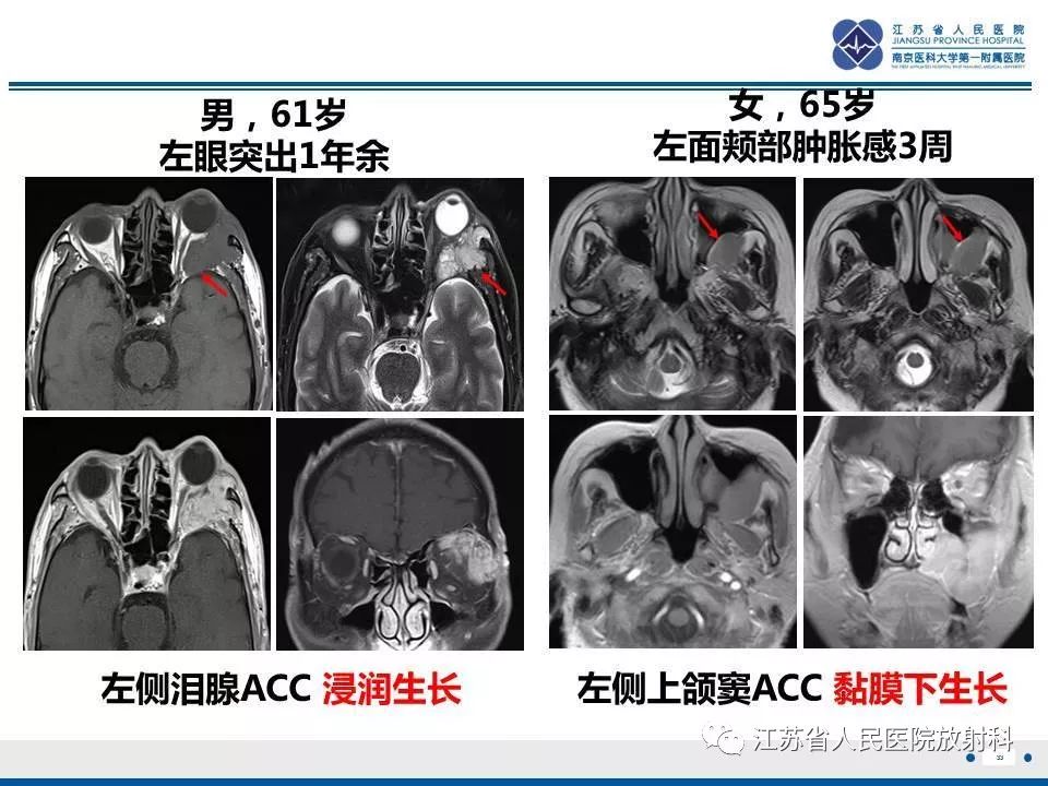 影像PPT - 【PPT】腺样囊腺癌-34