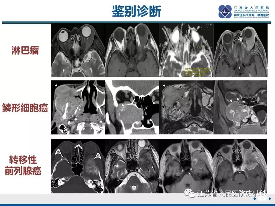 影像PPT - 【PPT】腺样囊腺癌-38