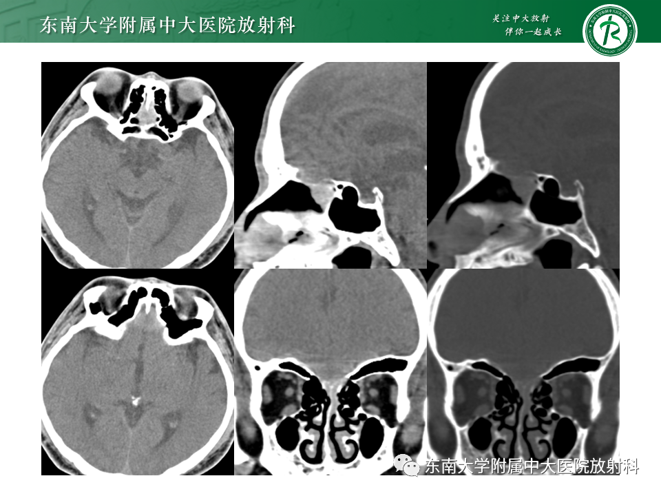 影像PPT - 【PPT】鼻颅底病变随访-11