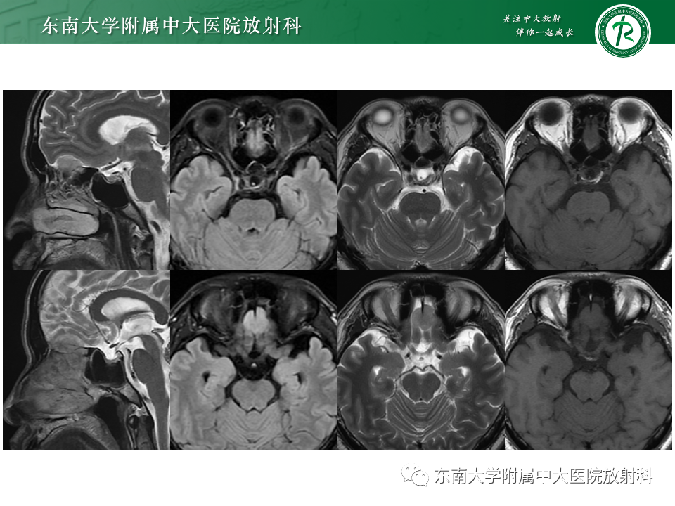 影像PPT - 【PPT】鼻颅底病变随访-12