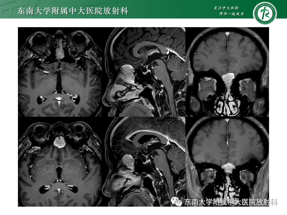 影像PPT - 【PPT】鼻颅底病变随访-13