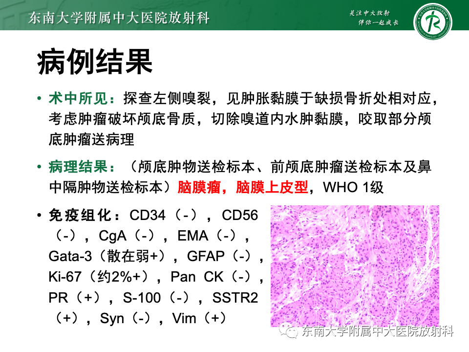 影像PPT - 【PPT】鼻颅底病变随访-14