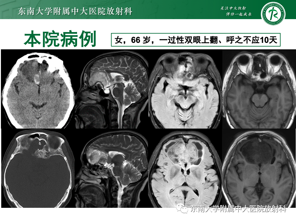 影像PPT - 【PPT】鼻颅底病变随访-15