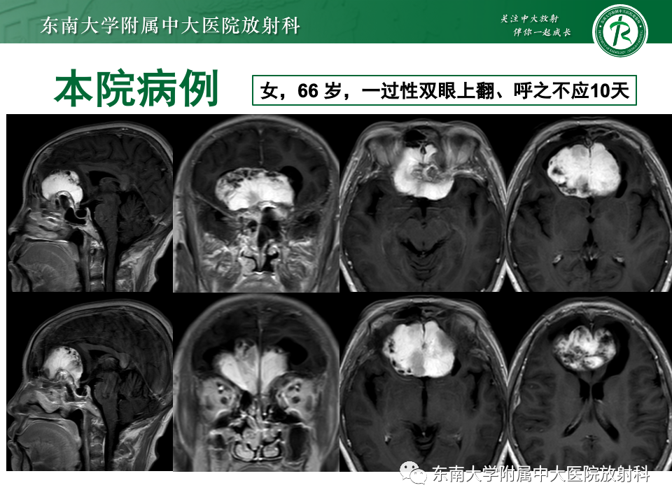 影像PPT - 【PPT】鼻颅底病变随访-16