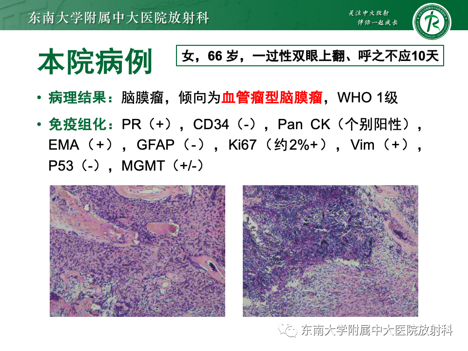 影像PPT - 【PPT】鼻颅底病变随访-17