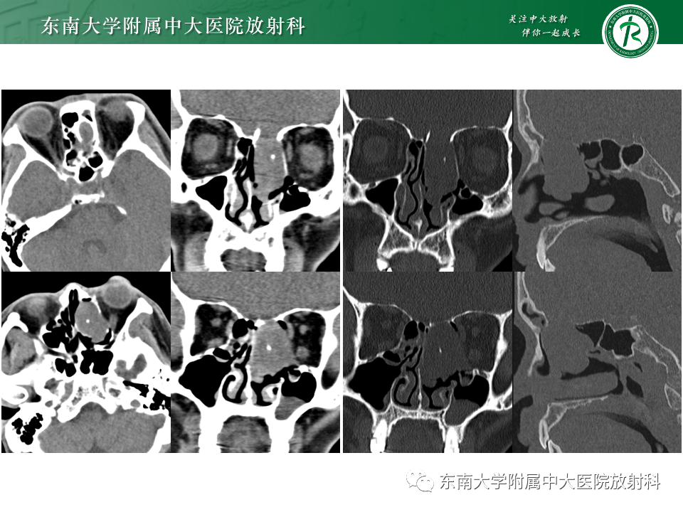 影像PPT - 【PPT】鼻颅底病变随访-21