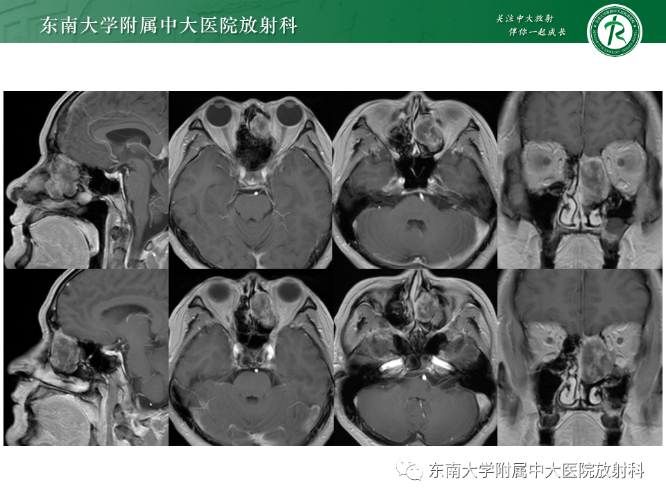 影像PPT - 【PPT】鼻颅底病变随访-22
