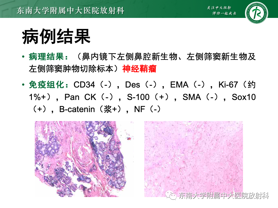 影像PPT - 【PPT】鼻颅底病变随访-24