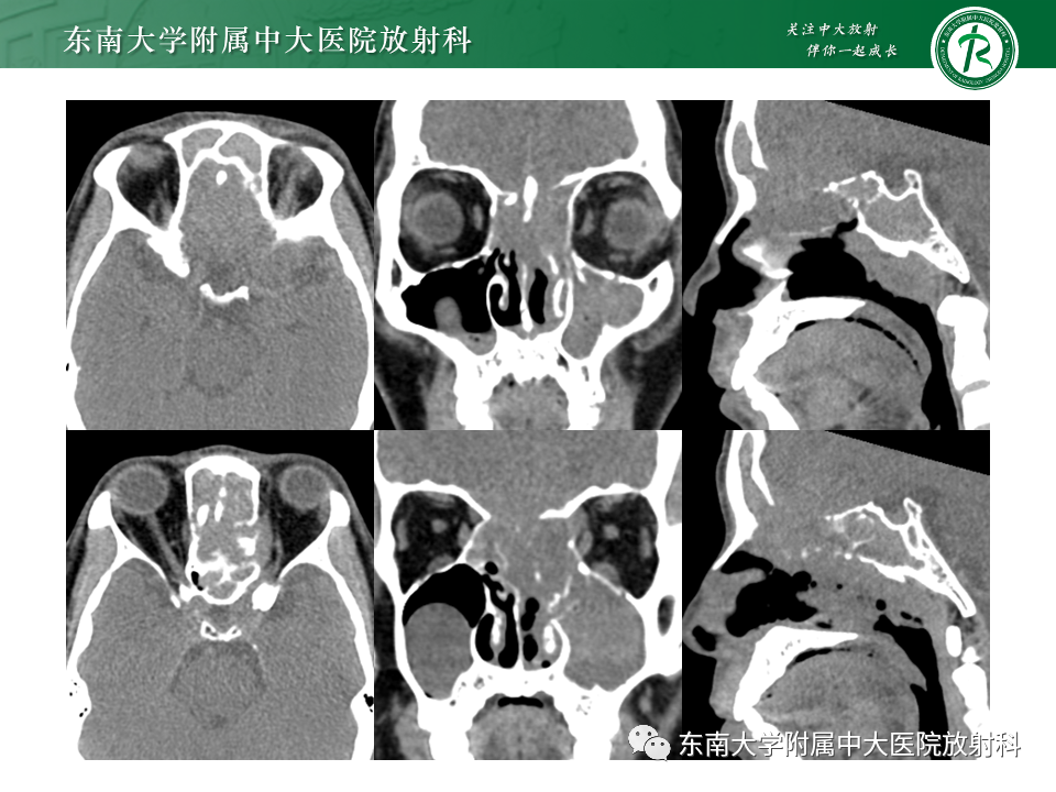 影像PPT - 【PPT】鼻颅底病变随访-29