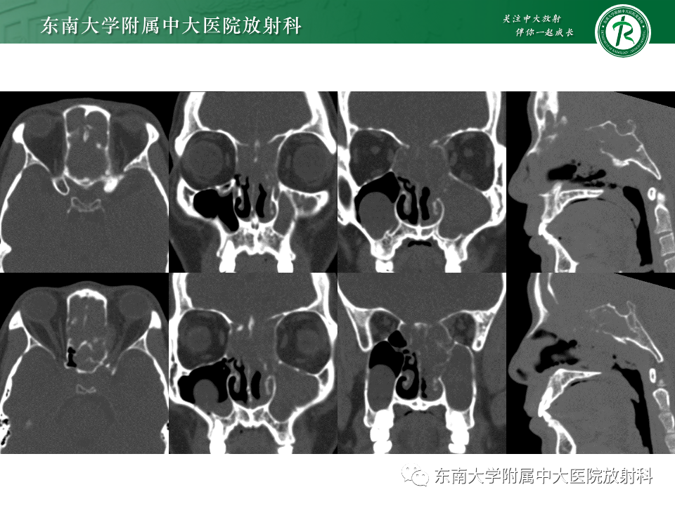 影像PPT - 【PPT】鼻颅底病变随访-30