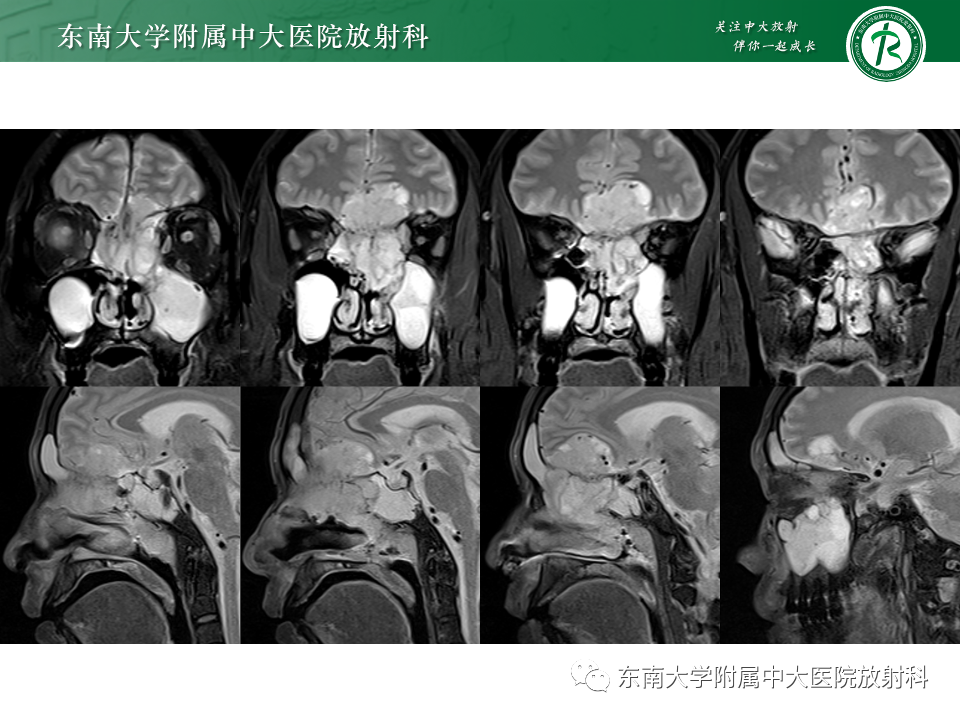 影像PPT - 【PPT】鼻颅底病变随访-31