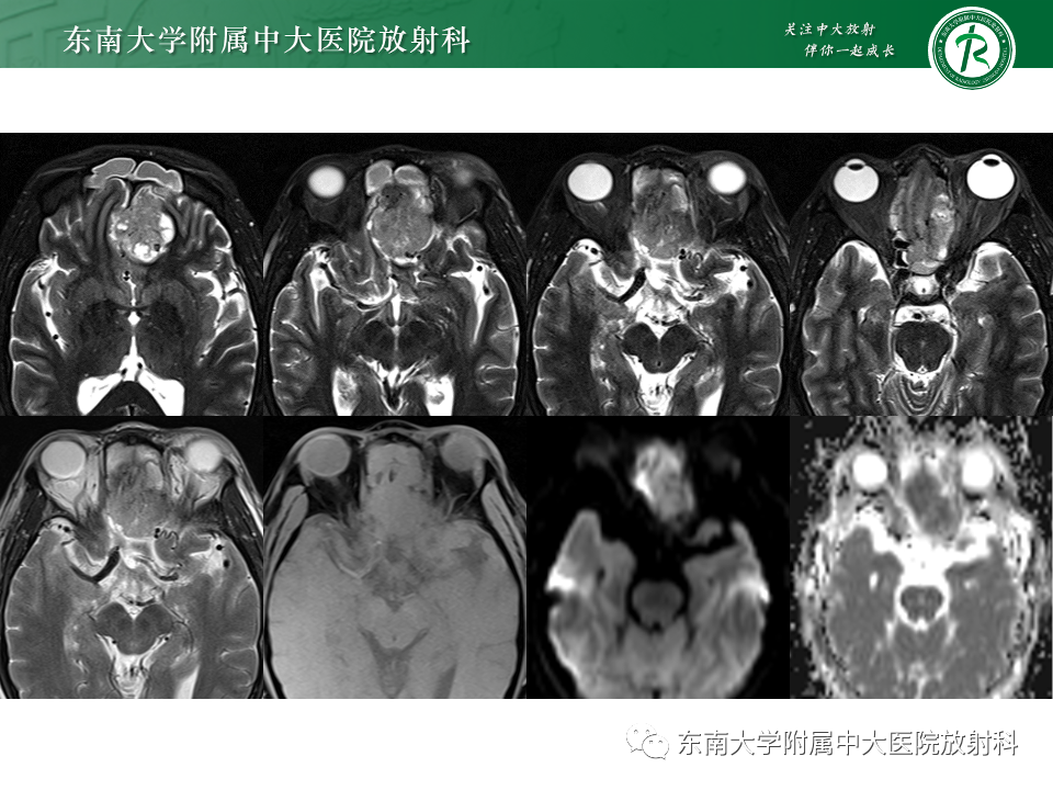 影像PPT - 【PPT】鼻颅底病变随访-32
