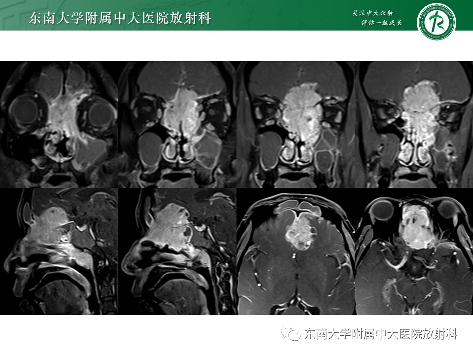 影像PPT - 【PPT】鼻颅底病变随访-33