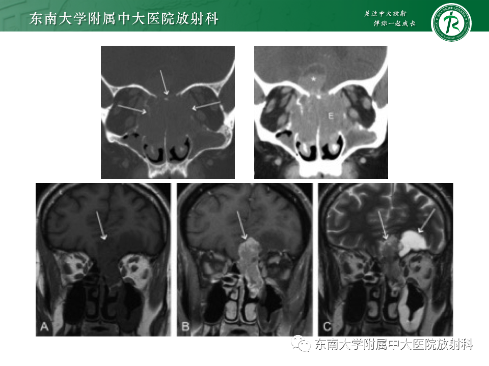 影像PPT - 【PPT】鼻颅底病变随访-38