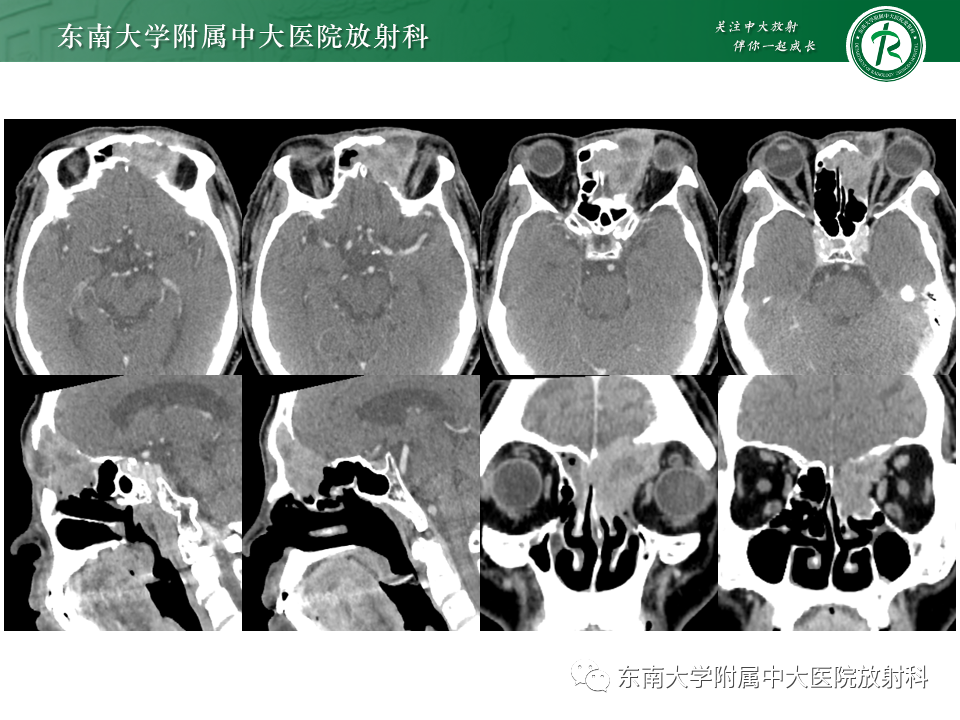 影像PPT - 【PPT】鼻颅底病变随访-42