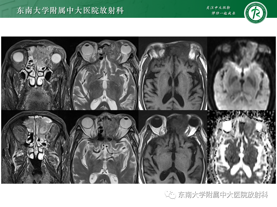 影像PPT - 【PPT】鼻颅底病变随访-43