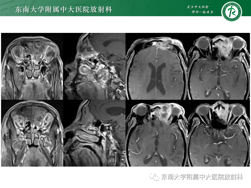 影像PPT - 【PPT】鼻颅底病变随访-44