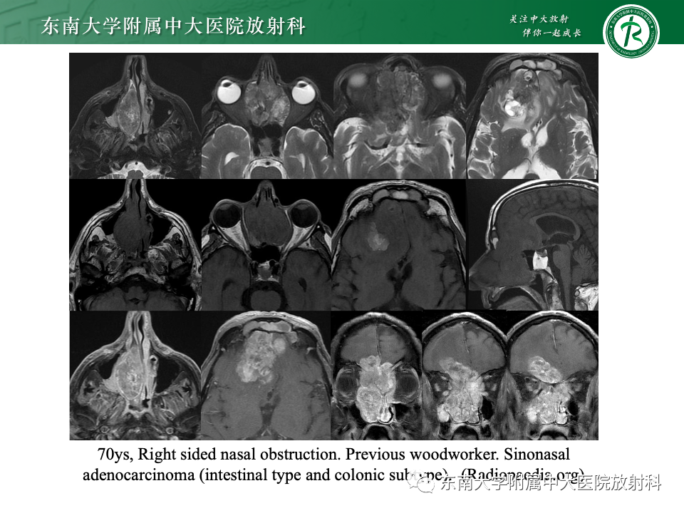 影像PPT - 【PPT】鼻颅底病变随访-49