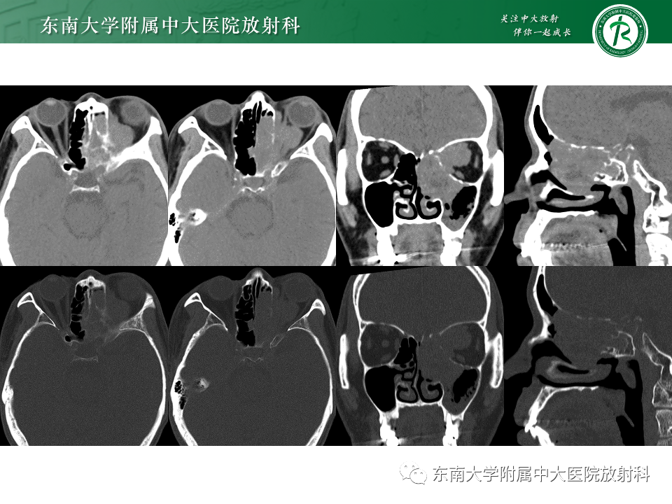 影像PPT - 【PPT】鼻颅底病变随访-51