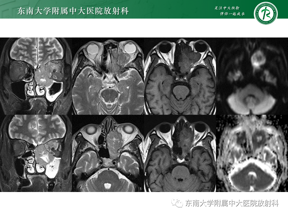 影像PPT - 【PPT】鼻颅底病变随访-52
