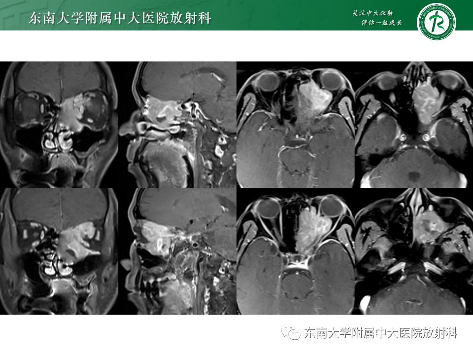 影像PPT - 【PPT】鼻颅底病变随访-53