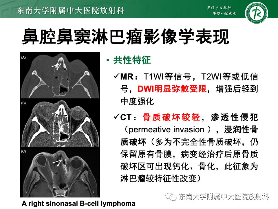 影像PPT - 【PPT】鼻颅底病变随访-56
