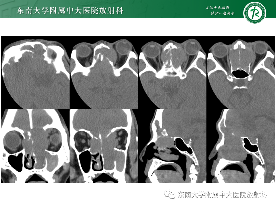 影像PPT - 【PPT】鼻颅底病变随访-61