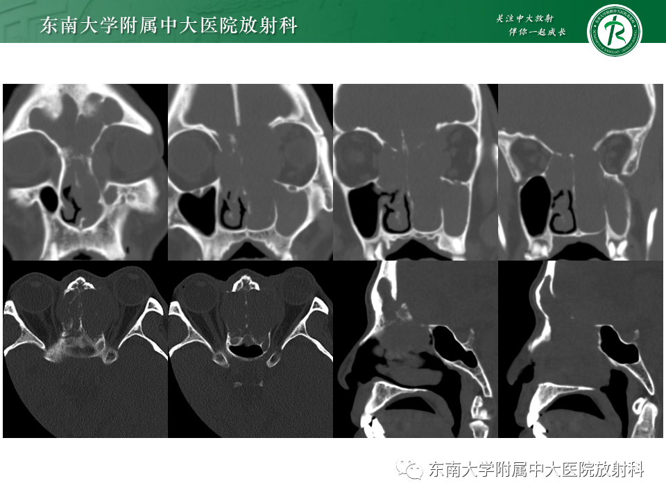 影像PPT - 【PPT】鼻颅底病变随访-62