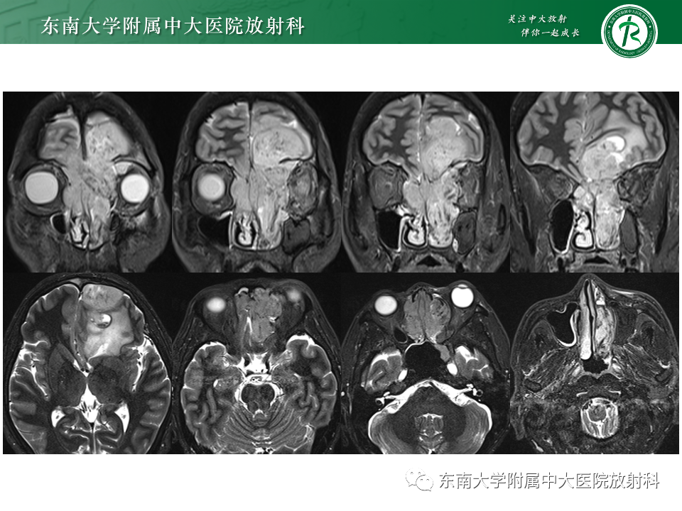 影像PPT - 【PPT】鼻颅底病变随访-63