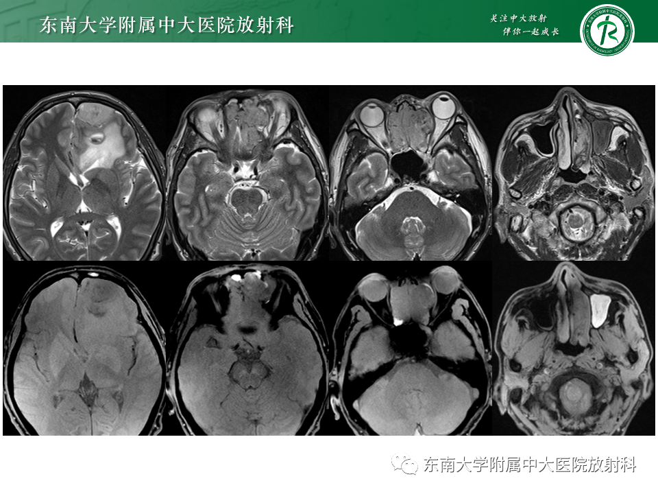 影像PPT - 【PPT】鼻颅底病变随访-64
