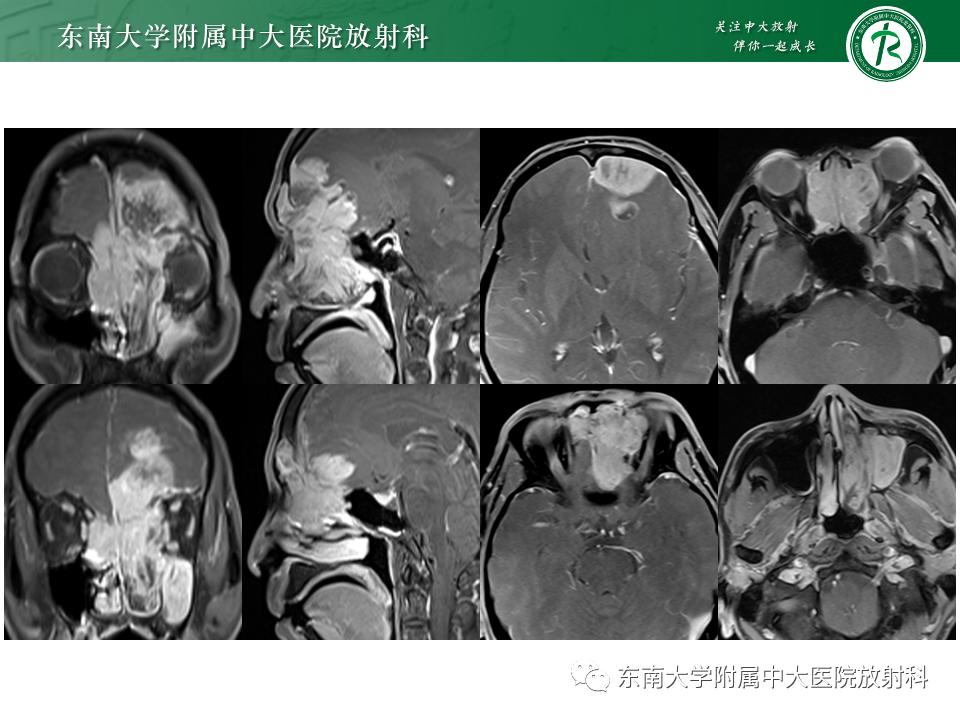 影像PPT - 【PPT】鼻颅底病变随访-65
