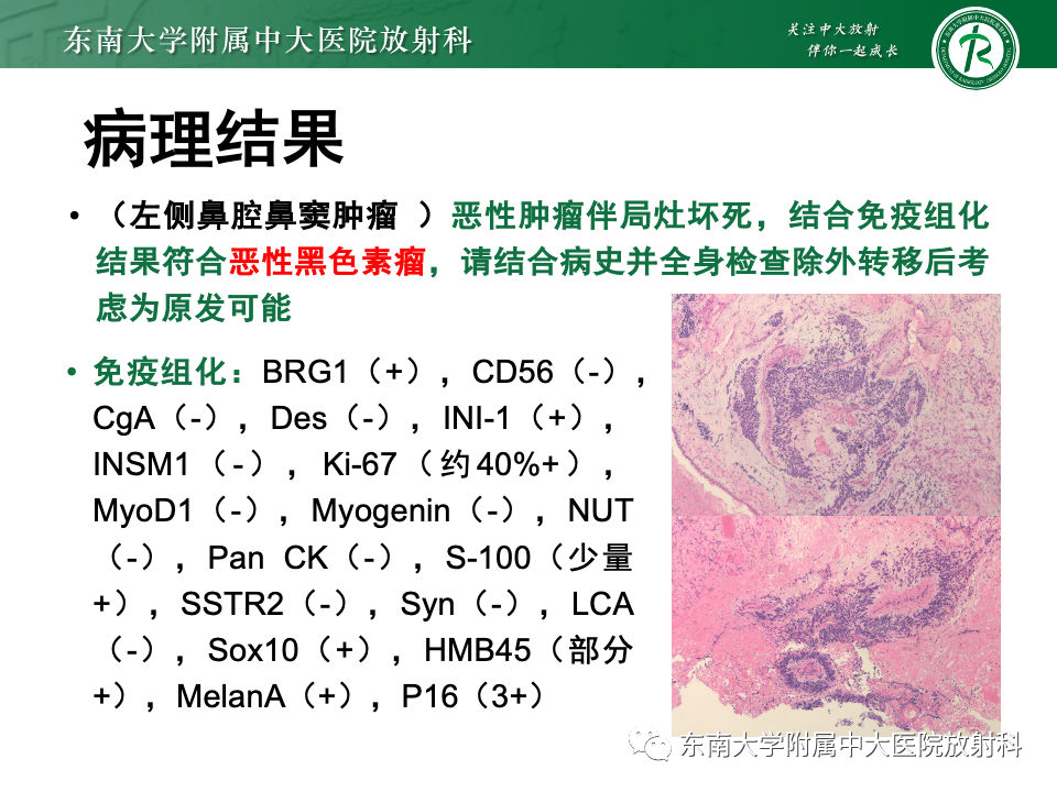 影像PPT - 【PPT】鼻颅底病变随访-66