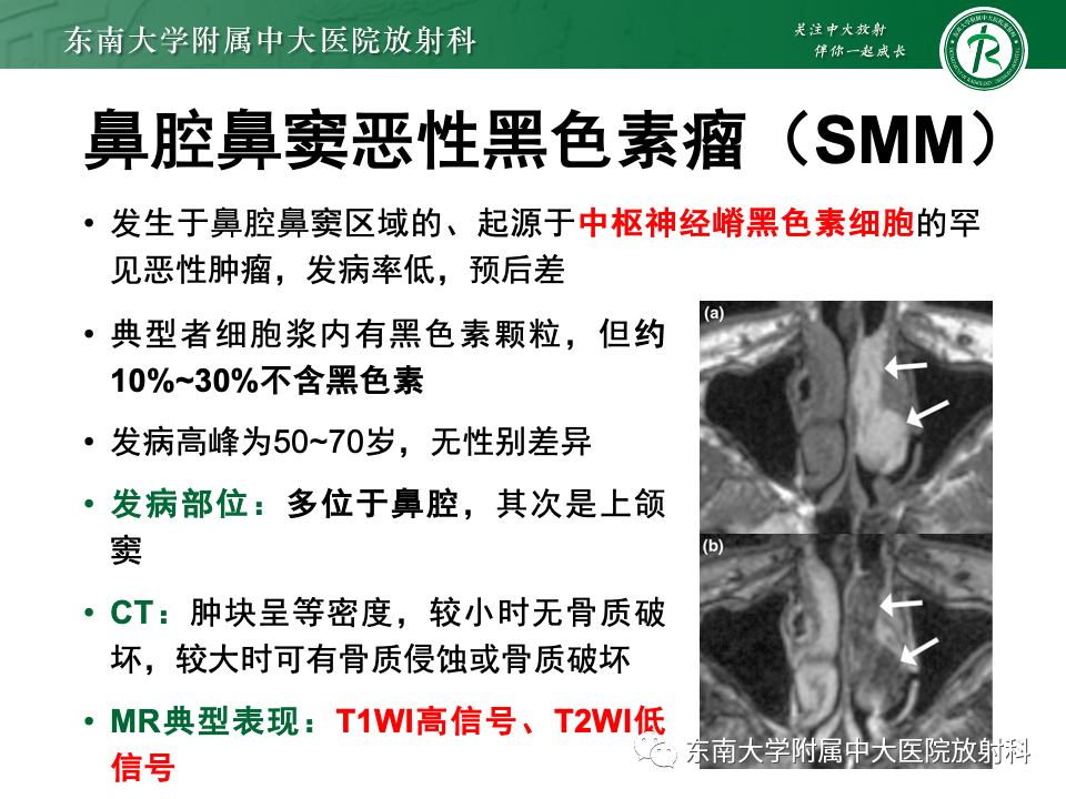 影像PPT - 【PPT】鼻颅底病变随访-67