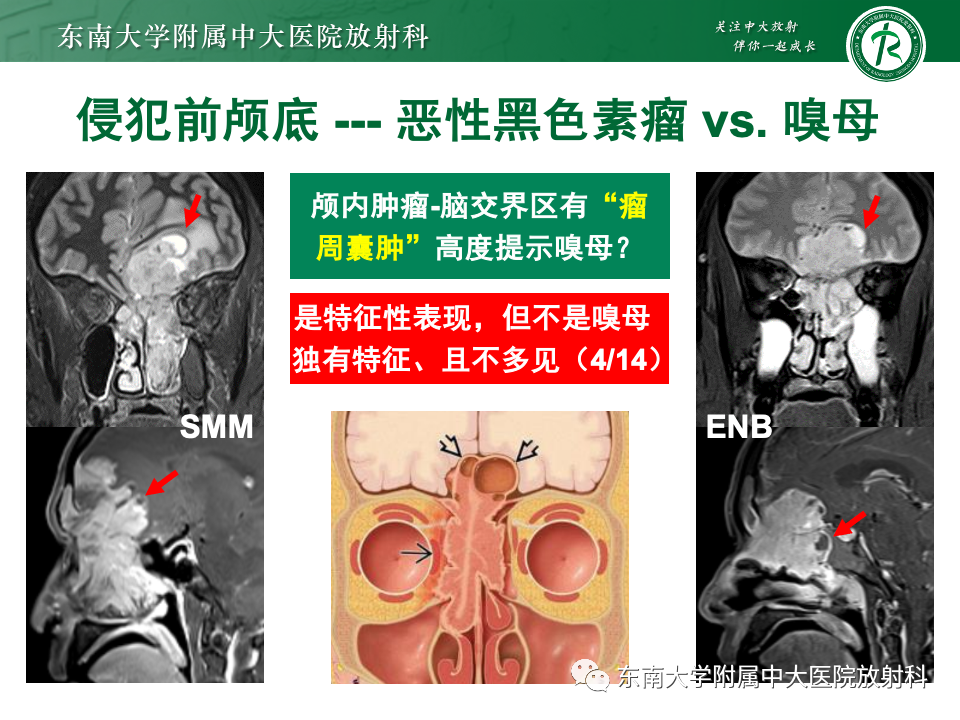 影像PPT - 【PPT】鼻颅底病变随访-69