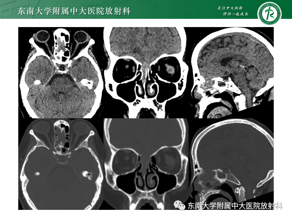 影像PPT - 【PPT】鼻颅底病变随访-72