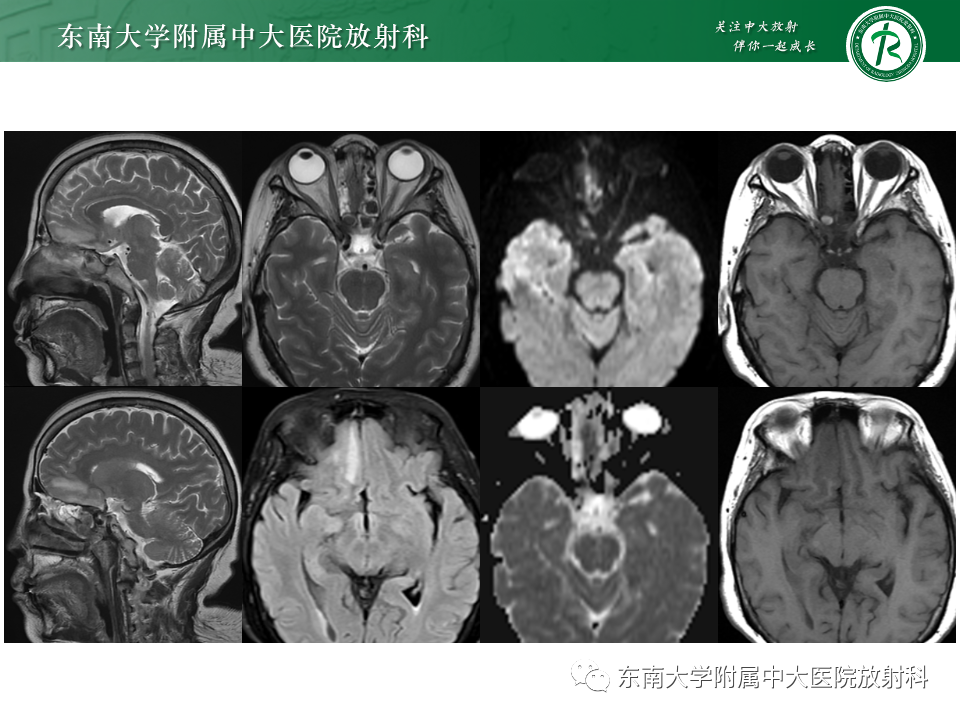 影像PPT - 【PPT】鼻颅底病变随访-73