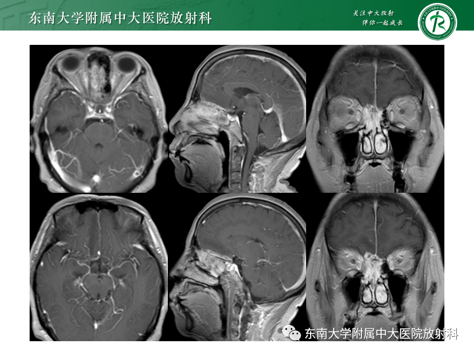 影像PPT - 【PPT】鼻颅底病变随访-74