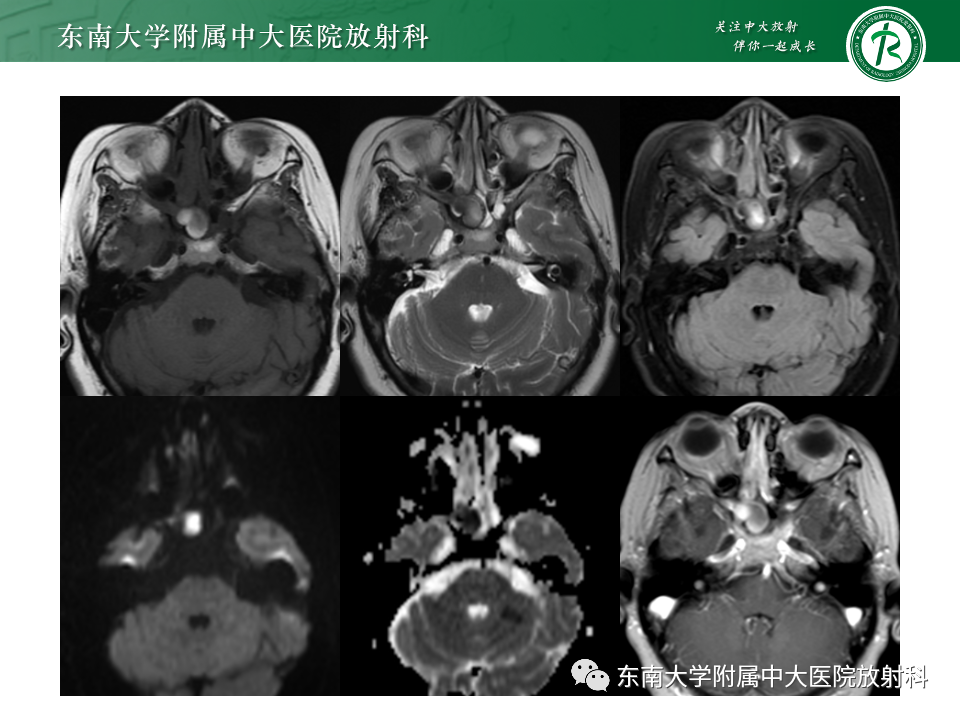 影像PPT - 【PPT】鼻颅底病变随访-75
